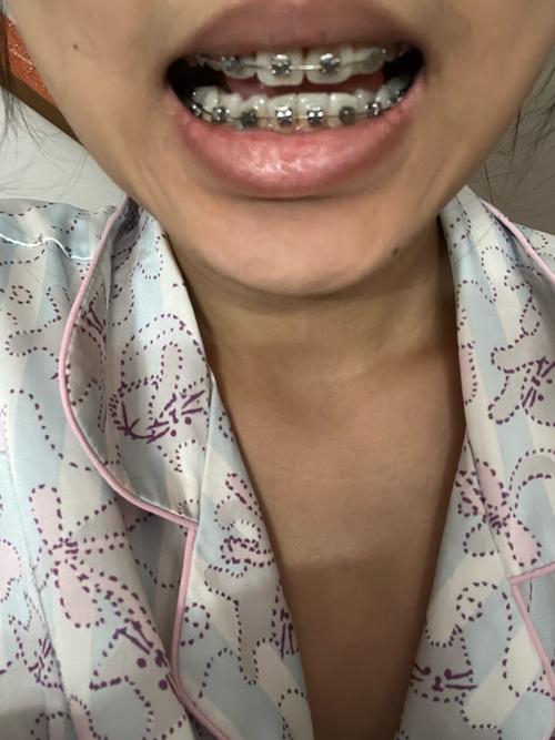 正畸后戴保持器难受，是正常现象吗？原因是什么？怎么缓解？-图3