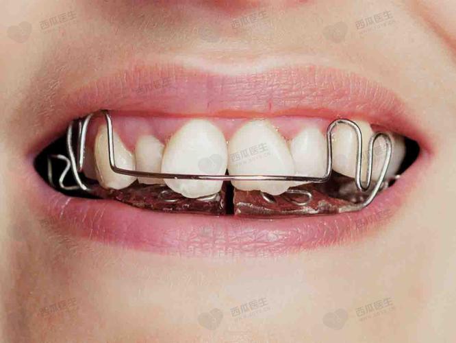 正畸后戴保持器难受，是正常现象吗？原因是什么？怎么缓解？-图2