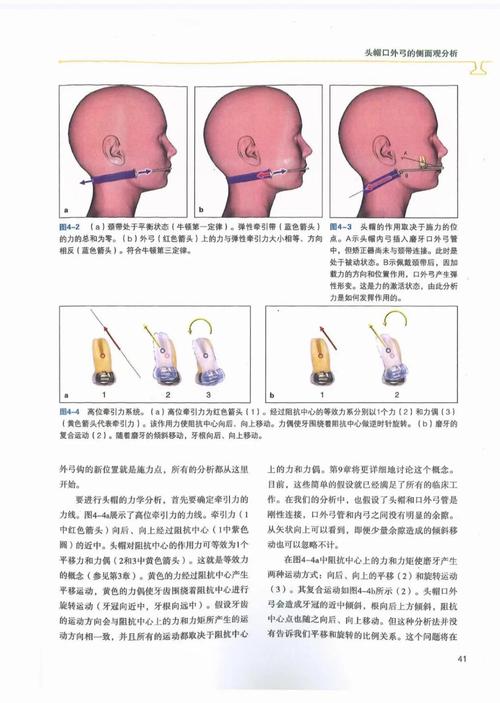 口腔正畸力学书籍，如何将力学原理转化为临床矫治力呢？-图3