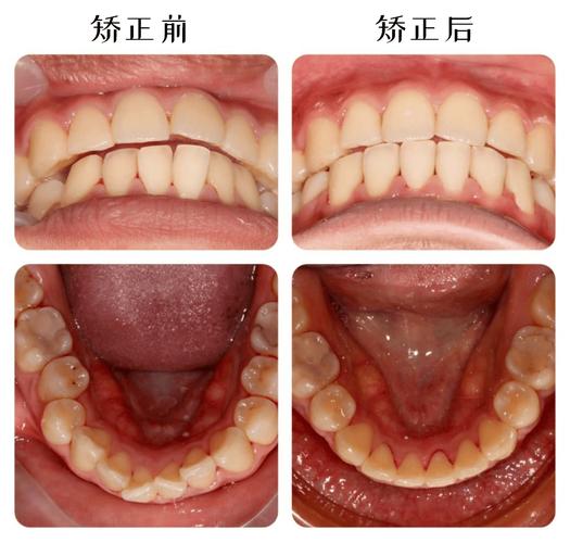 正畸矫正需拔哪几颗牙齿?-图3 正畸矫正需拔哪几颗牙齿?-图3