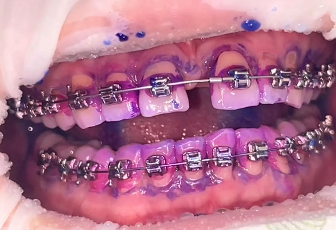 绿城口腔医院正畸效果如何?技术优势值得选吗?-图3 绿城口腔医院正畸效果如何?技术优势值得选吗?-图3