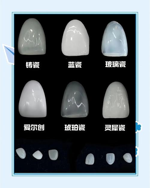 口腔瓷贴面粘结方法的关键步骤与操作技巧有哪些？-图2