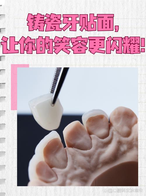 口腔瓷贴面粘结方法的关键步骤与操作技巧有哪些？-图3