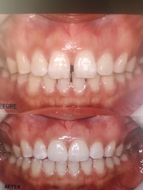 前牙贴面的预备方法-图2 前牙贴面的预备方法-图2