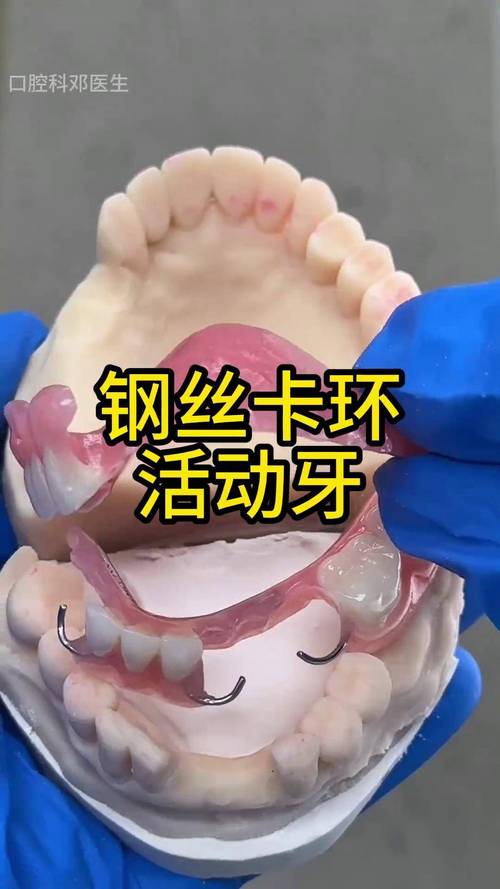 牙科卡环焊接方法有哪些关键操作要点？-图2