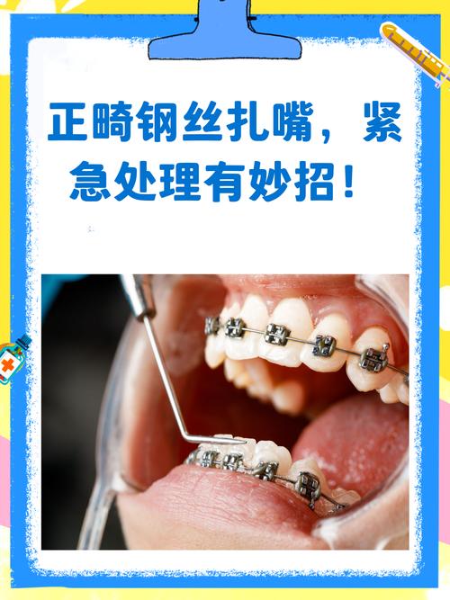 正畸钢丝究竟如何发力实现牙齿矫正移动的原理?-图2 正畸钢丝究竟如何发力实现牙齿矫正移动的原理?-图2