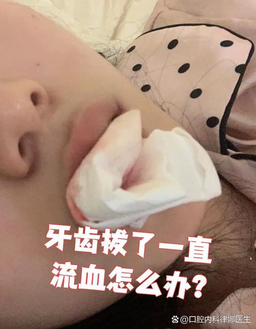 上后牙出血怎么办?快速有效的止血方法有哪些?-图2 上后牙出血怎么办?快速有效的止血方法有哪些?-图2