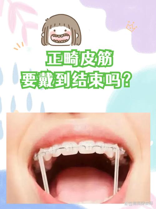 正畸后什么时候戴皮筋?戴多久合适?-图2 正畸后什么时候戴皮筋?戴多久合适?-图2