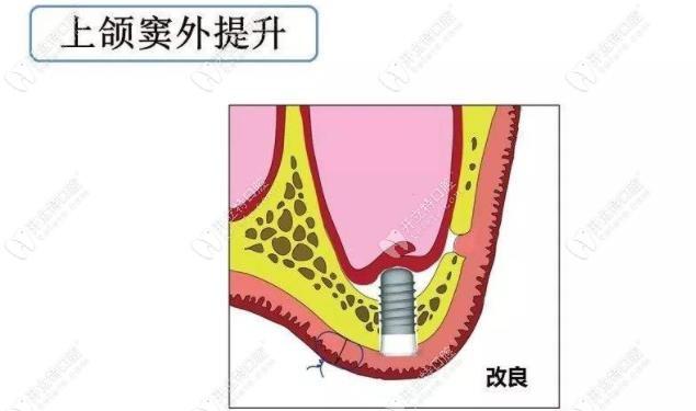 上额窦提升方法包括哪些？常见术式与应用选择？-图1