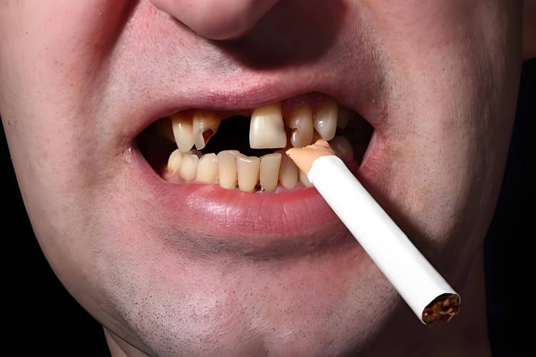吸烟导致 种牙失败-图1 吸烟导致 种牙失败-图1