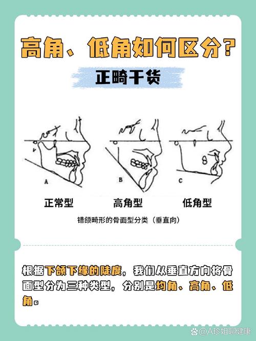 正畸研究生高角病例PPT研究重点与难点是什么?-图1 正畸研究生高角病例PPT研究重点与难点是什么?-图1