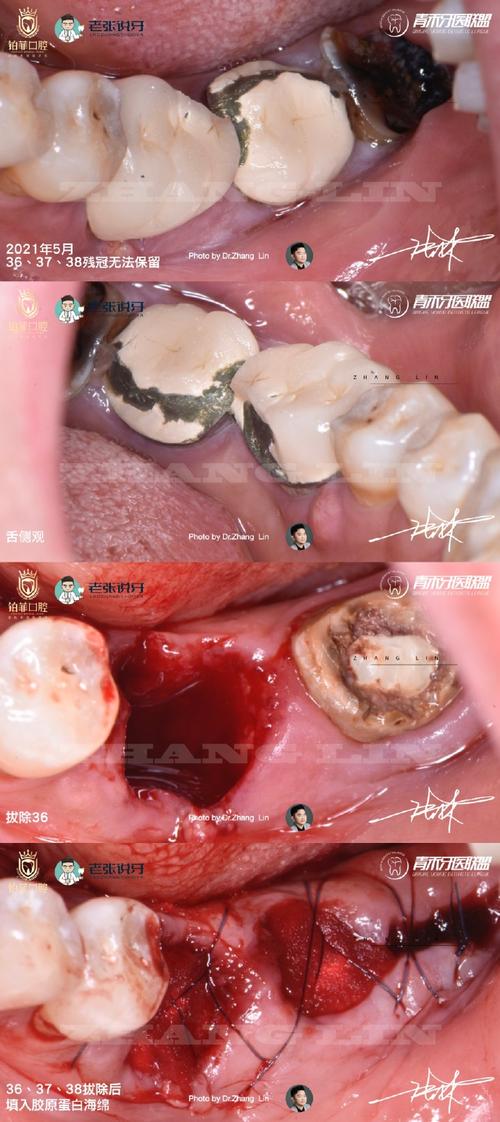 拔牙很久后种牙,会有哪些影响和注意事项?-图2 拔牙很久后种牙,会有哪些影响和注意事项?-图2