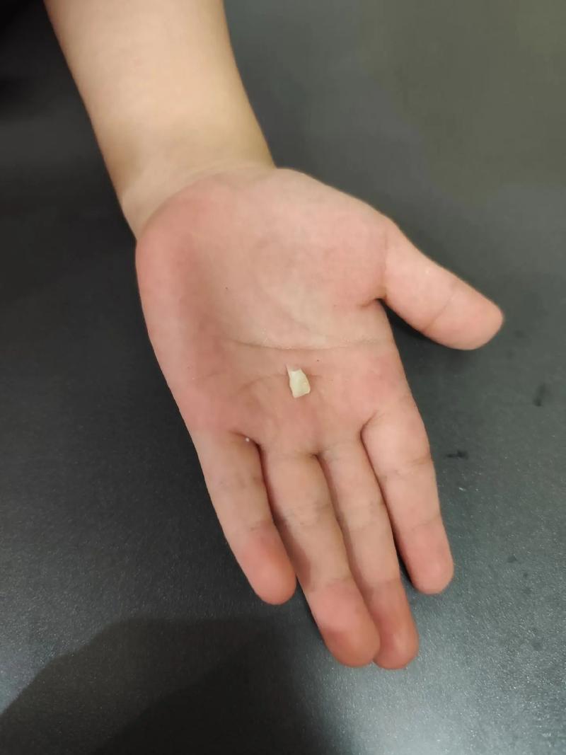 种牙 临时帽子掉了-图2