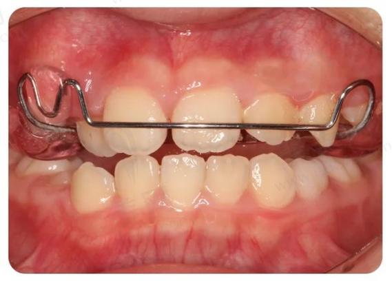 正畸扩弓过度会有哪些不良影响？-图2