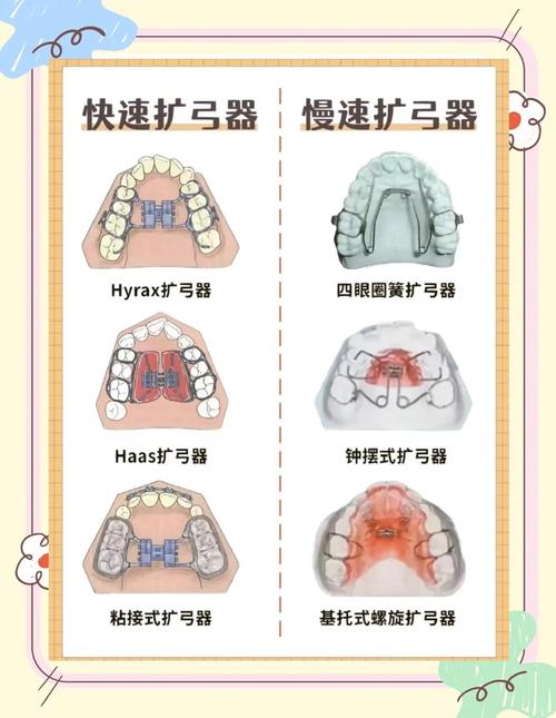 正畸扩弓过度会有哪些不良影响？-图3