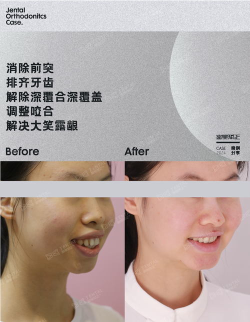 牙床突出的矫正方法有哪些？不同情况如何选择有效矫正方式？-图1