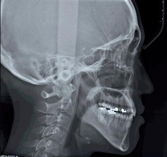 头颅侧位片正畸怎么拍-图1