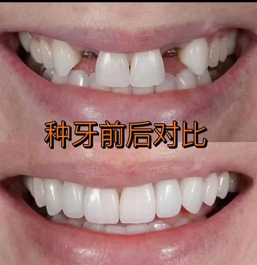 种植牙和真牙哪个更好？从使用体验、耐用性到维护成本全面对比-图1