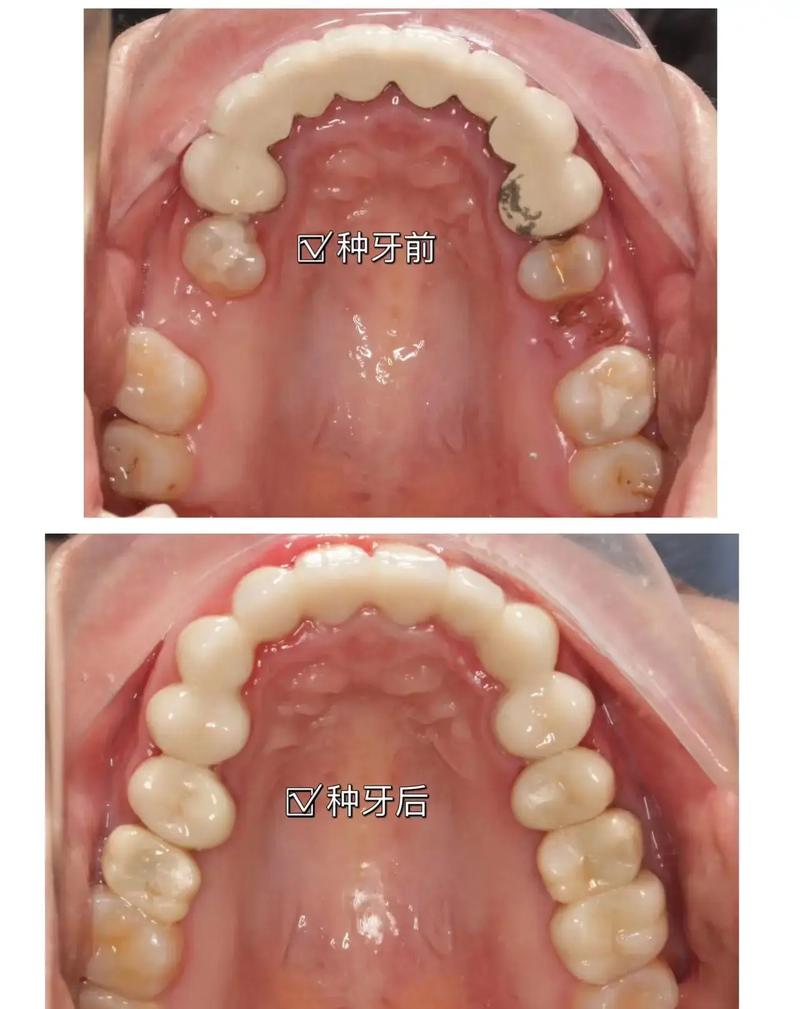 种植牙和真牙哪个更好？从使用体验、耐用性到维护成本全面对比-图2
