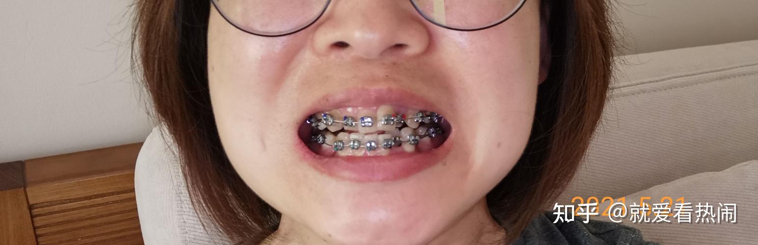 北京北大口腔正畸怎么样？有哪些优势？-图3