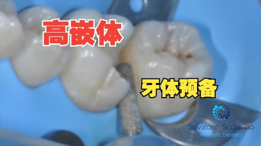 口腔嵌体制备方法的关键步骤与技巧有哪些？-图3