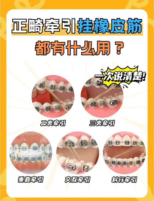 口腔正畸八字结扎方法如何操作？有哪些注意事项？-图2