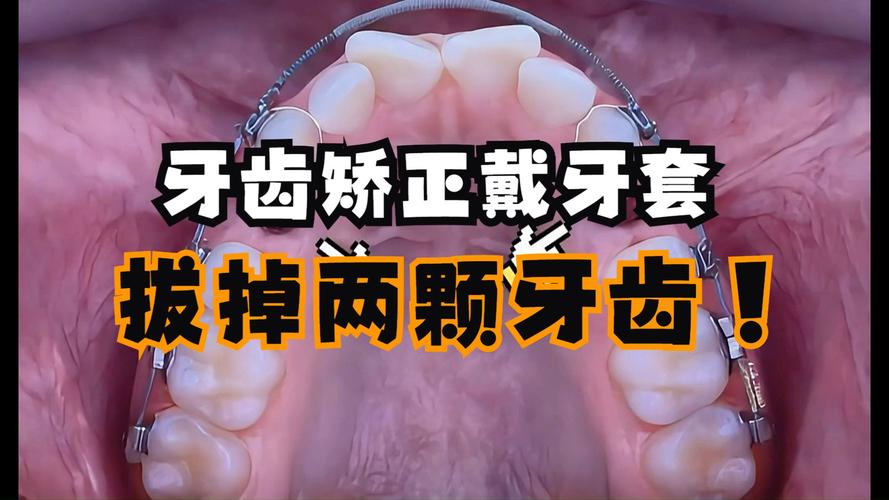 正畸牙齿能不能拔大牙-图2 正畸牙齿能不能拔大牙-图2