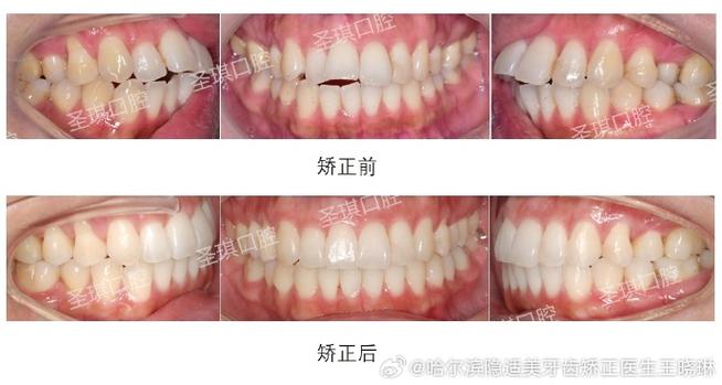 开颌手术VS正畸，选哪个更优？效果、风险、适用情况如何权衡？-图1