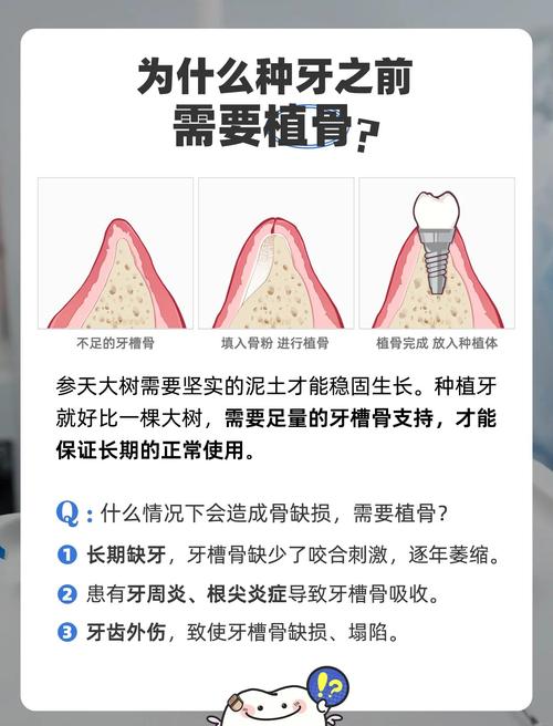 植骨手术后通常需要等待多长时间才能成功种牙？-图1