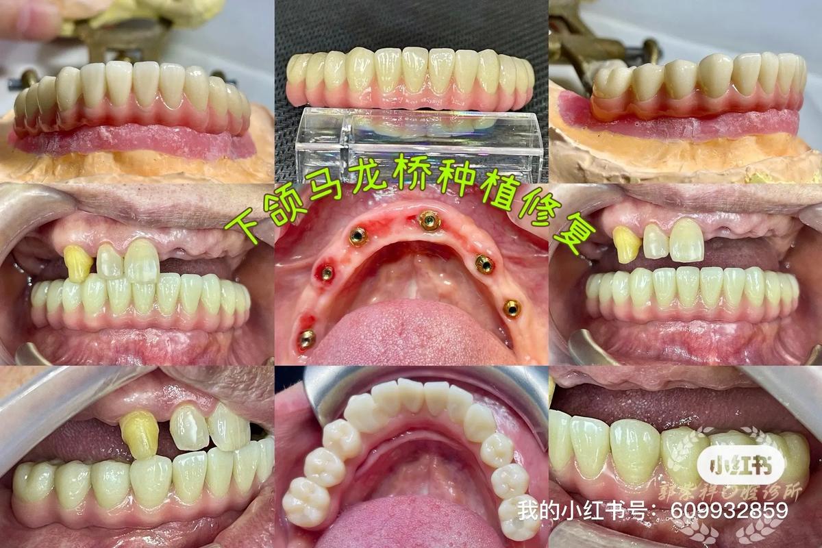 做牙桥好还是种牙好-图1 做牙桥好还是种牙好-图1