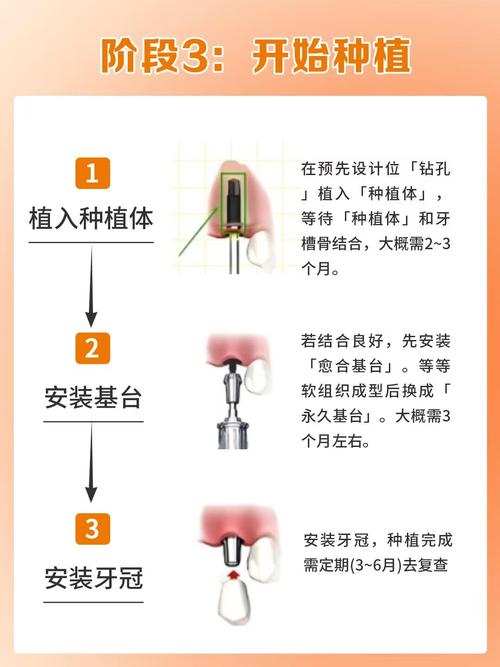 半口缺牙种牙怎么种?种植过程复杂吗?有哪些步骤?-图1 半口缺牙种牙怎么种?种植过程复杂吗?有哪些步骤?-图1