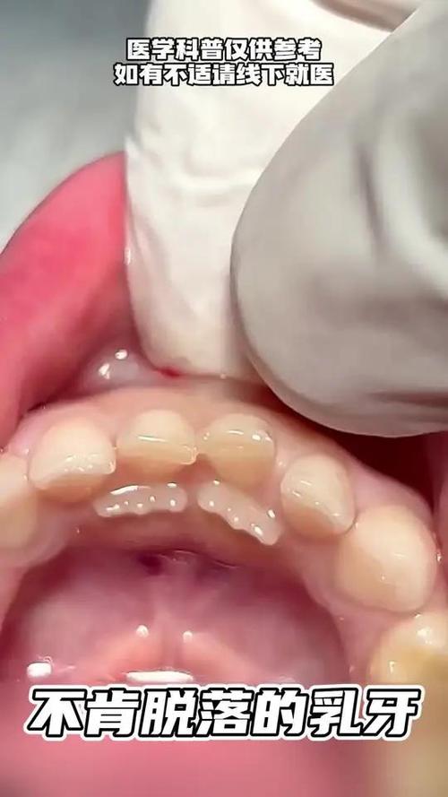 不同乳牙拔除方法有何差异?如何正确选择与操作?-图1 不同乳牙拔除方法有何差异?如何正确选择与操作?-图1