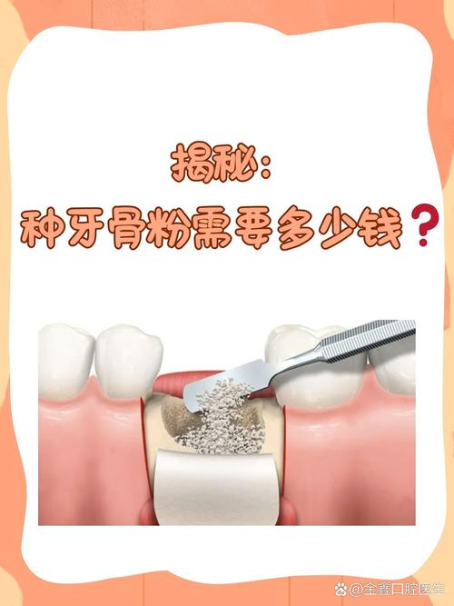 牙骨吸收能种牙吗?条件与方法解析-图1 牙骨吸收能种牙吗?条件与方法解析-图1