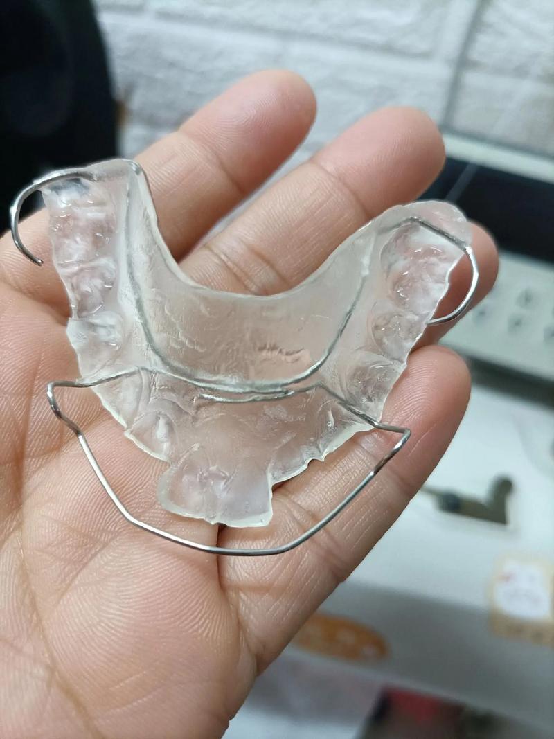 活动矫正器适合哪些牙齿正畸人群?效果和注意事项有哪些?-图2 活动矫正器适合哪些牙齿正畸人群?效果和注意事项有哪些?-图2