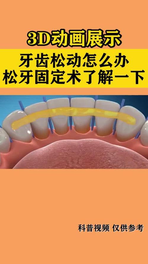 牙外伤导致牙齿松动,临床常用的固定方法有哪些?-图1 牙外伤导致牙齿松动,临床常用的固定方法有哪些?-图1