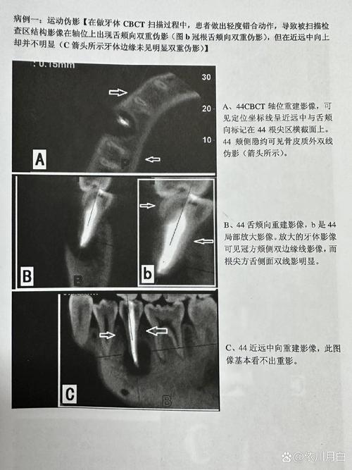 正畸头影测量分析诊断在错颌畸形矫正中起何关键作用?-图3 正畸头影测量分析诊断在错颌畸形矫正中起何关键作用?-图3