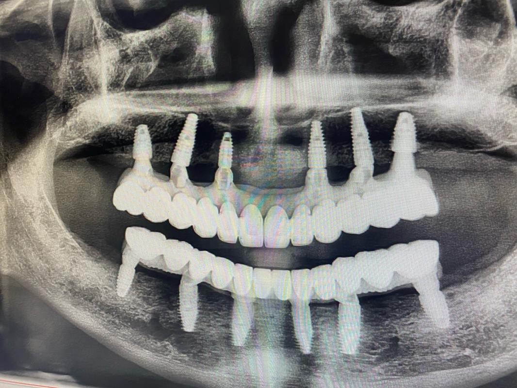 牙槽骨骨量不足,种植牙还有成功的机会吗?-图1 牙槽骨骨量不足,种植牙还有成功的机会吗?-图1