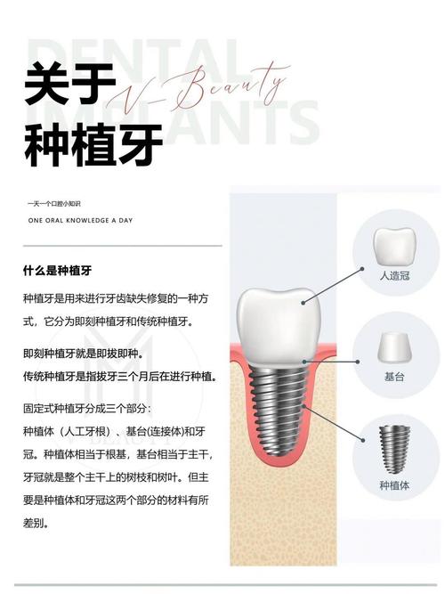 种牙怎么看牙好坏?材料、医生、技术是关键!-图2 种牙怎么看牙好坏?材料、医生、技术是关键!-图2