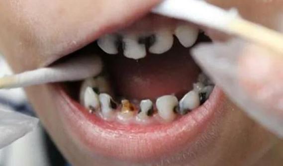 正畸后为何全口牙都蛀了？矫正过程藏隐患？-图2