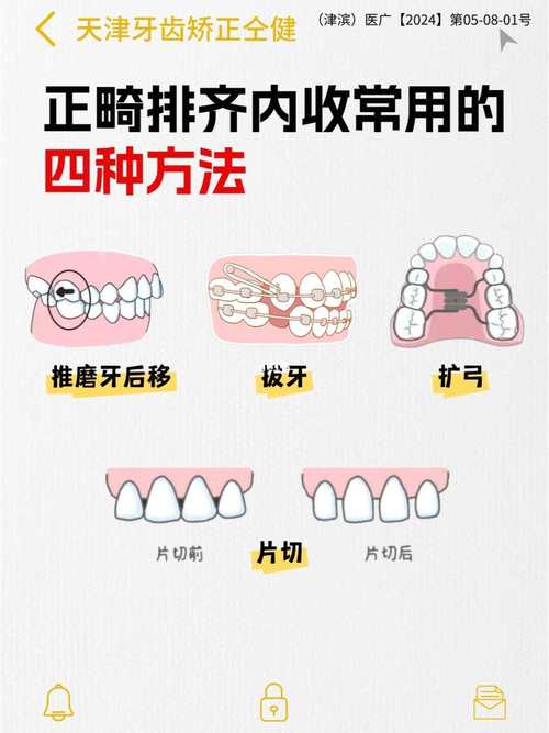 正畸矫正过程中前牙怎样实现有效内收？-图3