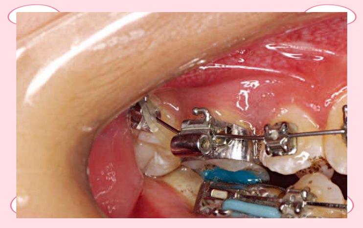 正畸带环固定方法的具体操作步骤有哪些？-图3