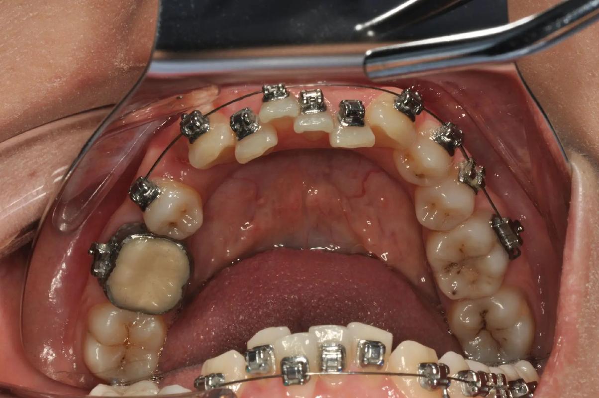 正畸带环固定方法的具体操作步骤有哪些？-图2