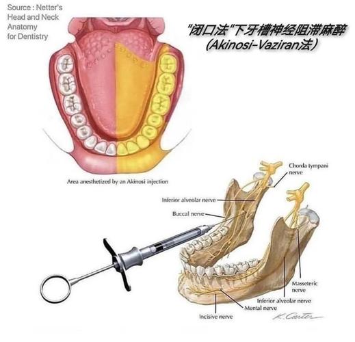 上颌前磨牙麻醉方法的选择依据、操作要点及注意事项有哪些?-图3 上颌前磨牙麻醉方法的选择依据、操作要点及注意事项有哪些?-图3