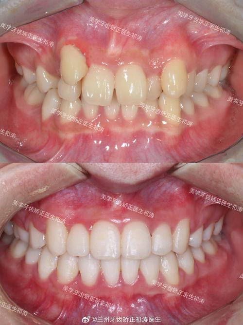 下前牙散在间隙正畸如何矫正?效果能保持多久?-图1 下前牙散在间隙正畸如何矫正?效果能保持多久?-图1