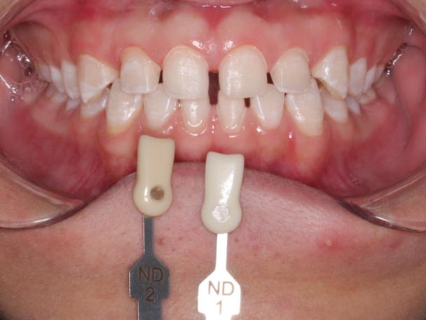 下前牙散在间隙正畸如何矫正？效果能保持多久？-图2