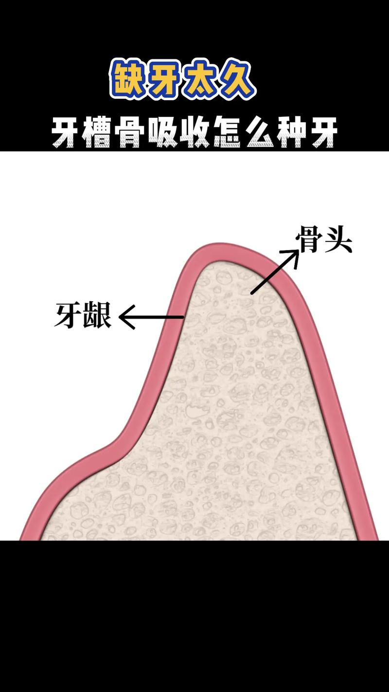 牙槽骨最少高度种牙-图1