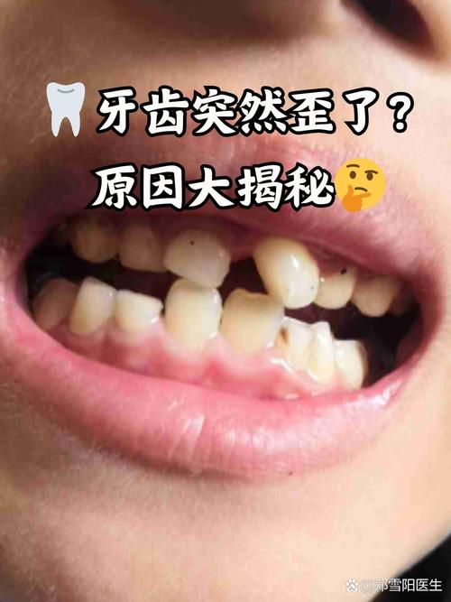 缺牙后牙齿倾斜,种牙前必须先处理倾斜问题吗?-图1 缺牙后牙齿倾斜,种牙前必须先处理倾斜问题吗?-图1