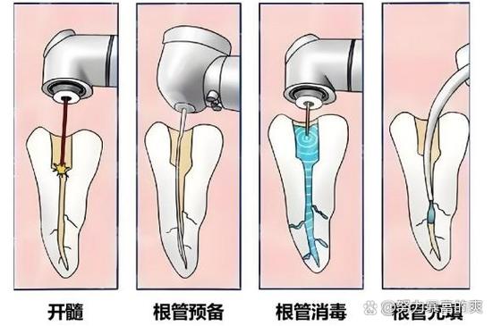 牙周炎微创治疗方法有哪些?疗效与传统比如何?-图1 牙周炎微创治疗方法有哪些?疗效与传统比如何?-图1