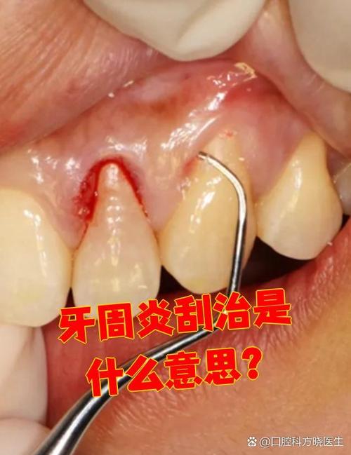 牙周炎微创治疗方法有哪些?疗效与传统比如何?-图3 牙周炎微创治疗方法有哪些?疗效与传统比如何?-图3