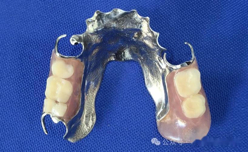 口腔正畸邻间钩的制作-图2 口腔正畸邻间钩的制作-图2